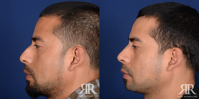 Rhinoplasty - Rhinoplasty