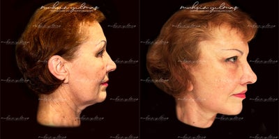 45-54 year old woman treated with Deep Plane Facelift, Neck Lift, Lip Lift, Brow Lift, Double Eyelid Surgery - This 55-64-year-old patient underwent a combination of Deep Plane Facelift, Neck Lift, Brow Lift, and Double Eyelid Surgery to achieve a refreshed and youthful appearance. The Deep Plane Facelift and Neck Lift focused on lifting and redefining facial and neck contours, addressing sagging skin and restoring a natural-looking structure. The Brow Lift elevated the brows, enhancing her overall expression with a more awake and vibrant look. The Double Eyelid Surgery refined the eye area, creating a balanced and rejuvenated appearance. At 1 month post-operative, the results already demonstrate significant improvement, with swelling continuing to subside and final results expected in the coming months.