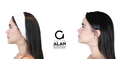 25-34 year old woman treated with Nonsurgical Facelift - Lift-!N is the latest HIFU (High-Intensity Focused Ultrasound) aesthetic technology that focuses all its energy in a high frequency ultrasound beam to a specific area of the skin, without making incisions or using needles on the patient, in order to reshape their tissue by thermal ablation.