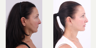55-64 year old woman treated with Facelift, Neck Lift, Buccal Fat Removal - 60 year old patient 6 months after Facelift, Neck lift and Buccal Fat Removal