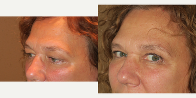 45-54 year old woman treated with Brow Lift - upper blepharoplasty and endobrow lift