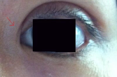 Surgeon Cut into Epicanthal Fold During Eyelid Surgery, What Are My Options? Doctor Answers, Tips