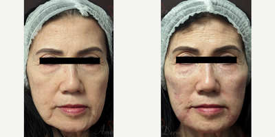 55-64 year old woman treated with Liquid Facelift, Juvederm, Voluma, Vollure, Volbella, Restylane - Liquid facelift with filler injection in cheeks, under eyes (4D Lyft) & marionette lines (Juvederm, Voluma, Vollure, Volbella, Restylane, RHA)
