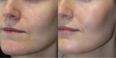 35-44 year old woman treated with Vampire Facial - 42 yo female seeking rejuvenation, hydration and resurfacing of aging skin, after a series of 3 Vampire Facial! Loves the Look!!