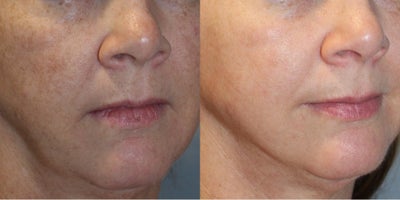 45-54 year old woman treated with Vampire Facial - 49 yo lovely woman who chose to treat herself to the Vampire Facial, successfully clearing her dark spots, enlarged pores, dry/brittle surface and adding hydration- all DNA driven rejuvenating procedures!