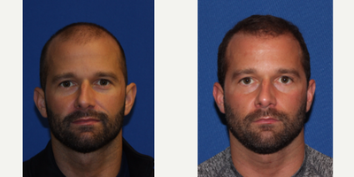 25-34 year old man treated with FUE Hair Transplant - 31 year old patient who underwent FUE hair transplant procedure. He received total of 2,020 grafts mainly to the frontotemporal recession and mid scalp area to restore density and achieve natural frontal hair line.