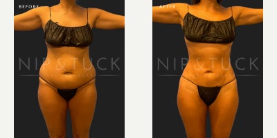 38 year old woman treated with awake Lipo 360 - 38-Year-Old Female | 3 Months Post-OpProcedure Taken: Awake Liposuction This patient experienced significant skin laxity following massive weight loss but wanted to avoid the scars typically associated with a tummy tuck.At just 3 months post-op, shes already showing remarkable contour improvement with her #NaturallyNip results no tummy tuck required. We tailored her treatment plan to align with her goals, combining surgical precision with scar-conscious technique. Shes healing beautifully and still early in her transformation journey final results will continue to refine over the coming months.Every body is different. Every plan is personalized.