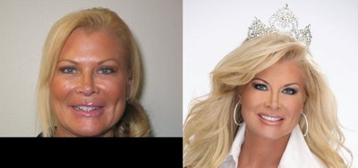 Full Mouth Smile Makeover -
Patient unhappy with smile due to shape, asymmetry and color of teeth. Treatment included a combination of porcelain veneers and porcelain crowns to obtain patient's ideal smile.