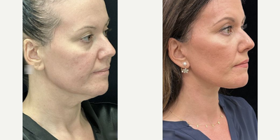 44 year old woman treated with Deep Plane Facelift, Neck Lift, Facial Fat Transfer - 44 year old woman treated with Deep Plane Facelift, Neck Lift, Facial Fat Transfer