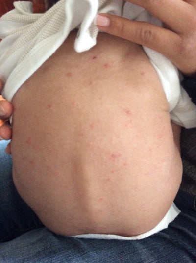 I have a baby that has a rash all over his face, and body ...