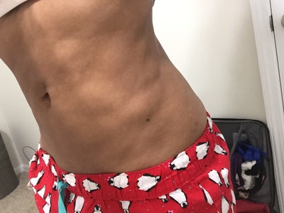 lipo revision stomach lumps left rid would realself