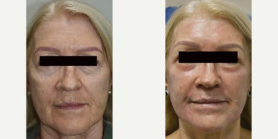 Erbium laser resurfacing in Los Angeles before and after photos. - Two weeks can change your life. Just ask our patient that finished a 2 week recovery after ONE deep erbium laser resurfacing procedure. She told us she looks 10-15 years younger. You be the judge.