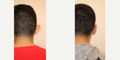 25-34 year old man treated with Ear Surgery - This 27-year-old male is one week after undergoing bilateral otoplasty. The primary objective in correcting this young mans prominent ears, is to establish an anti-helical fold. He was born without this critical bend in his upper and middle ear cartilage. This procedure is accomplished by placing buried sutures through an incision behind the ear in the natural skin crease.