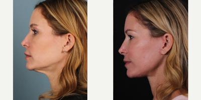 45-54 year old woman treated with Mini Facelift, MACS Facelift, SMAS Facelift - MACS facelift, mini-facelift B&A.