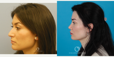 35-44 year old woman treated with Rhinoplasty - 10 years later it still looks amazing