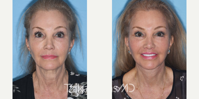 65-74 year old woman treated with Facelift - Extended Deep Plane Facelift, Full face eCO2 laser resurfacing & Lip lift