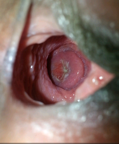 Cockhead Ballooning My Fertile Vaginal 11