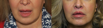 Patient treated with Lip Lift - LIP LIFT The new it procedure, an alternative to constant lip fillers