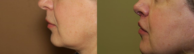 Patient treated with Lip Lift - LIP LIFT The new it procedure, an alternative to constant lip fillers