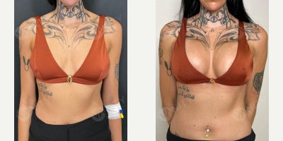 Breast Augmentation with 450 CC Implants - Breast Augmentation with 450 CC Implants