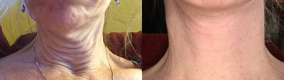 Woman treated with Facelift - Woman treated with Facelift