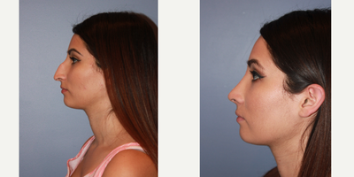 25-34 year old woman treated with Rhinoplasty - Rhinoplasty
