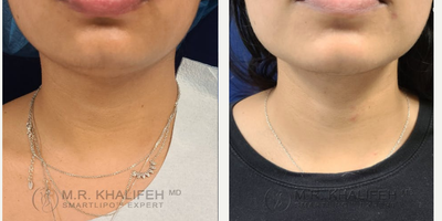 Laser Liposuction - Laser Liposuction