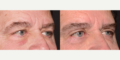 55-64 year old man treated with Eyelid Surgery - Patient wanted to fix his droopy eyelids and under-eye bags.