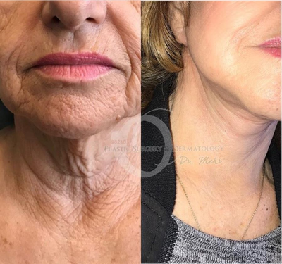 Woman treated with Neck Lift - Woman treated with Neck Lift.