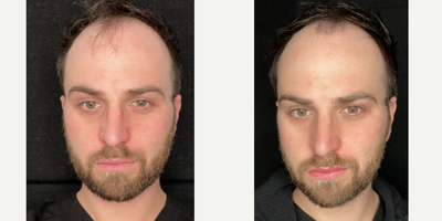 FIRST TIME FILLER - Jordan wanted a more sculpted jawline but had never received filler before. So, he trusted us to give him the chiseled, but natural, look he really wanted. By strategically placing filler into the target areas around his jawline, upper cheek, and chin, we were able to give him the masculine, Superman look of his dreams.