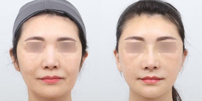 45-54 year old woman treated with AccuLift, Mini Facelift - This before-and-after photo showcases the results of a comprehensive facial contouring and rejuvenation procedure. Accu jawline and double chin contouring refined the lower face, while forehead and front cheek enhancement restored youthful volume. Nasolabial fold correction softened smile lines for a smoother appearance.A Mini Face Lift with Endotine fixation, along with lateral and lower lifting techniques, improved facial sagging and definition. Eye revision surgery further enhanced symmetry, resulting in a naturally lifted, balanced, and refreshed look.