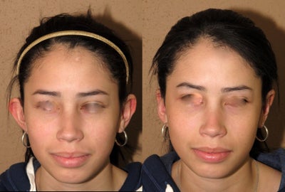 Otplasty/ears pinback -
Otoplasty or ear set-back performed under local anesthesia