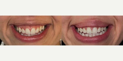 Gummy Smile Treatment - Using Botox/Dysport for Gummy Smile