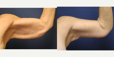 Bilateral Brachioplasty and Liposuction of the Arms - Bilateral liposuction and brachioplasty of the arms
