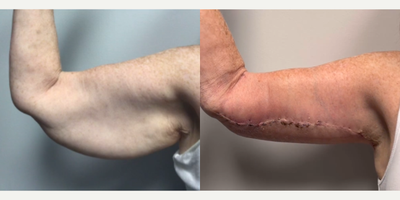 55-64 year old woman treated with Arm Lift - Lets check on that 59 yo patient who you watched get a brachioplasty 3 weeks ago