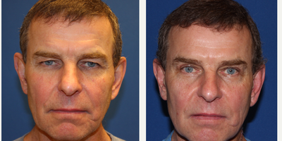 55-64 year old man treated with Eyelid Surgery - This patient underwent functional upper blepharoplasty. If patient has excess laxity of upper eyelid skin, the hooding of the eyelid skin can begin to obstruct visual field. Patient will go through a special visual field test to confirm that the visual field obstruction is indeed due to skin laxity. If it is confirmed that blepharoplasty will improve the visual field test, then it is considered medical-necessity procedure and will be covered by insurance.