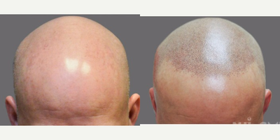 25-34 year old man treated with Hair Loss Treatment Scalp MicroPigmentation (SMP) - Scalp MicroPigmentation (SMP)