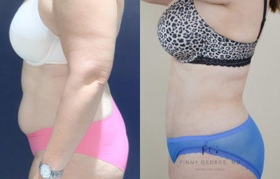 35-44 year old woman treated with Liposuction - This patient wanted to avoid a tummy tuck and requested liposuction to help shape her contour.