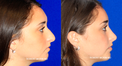 Rhinoplasty Before & After - Rhinoplasty before & after