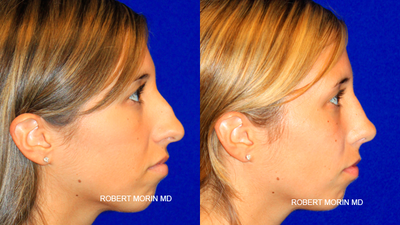Rhinoplasty Before & After - rhinoplasty before & after