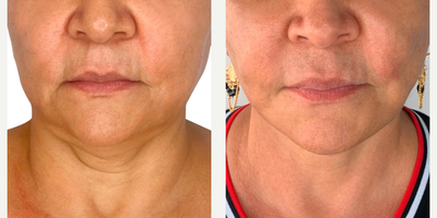 Woman treated with Deep Plane Facelift - Woman treated with Deep Plane Facelift