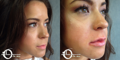 18-24 year old woman treated with Lip Augmentation Restylane - Excellent results for lips