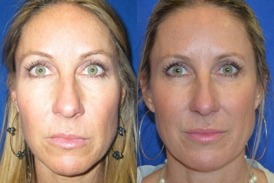 Injectable Fillers - This patient came in wanting to discuss natural-looking treatments for facial rejuvenation. After consulting with Dr. Ho about options for collagen stimulation the patient elected to have a sculptra treatment series.