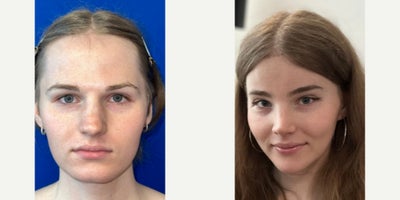 18-24 year old transgender woman treated with Facial Feminization Surgery - Facial Feminization