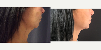 58 year old woman treated with Ultherapy - Ultherapy non surgical lift for lower face and neck.