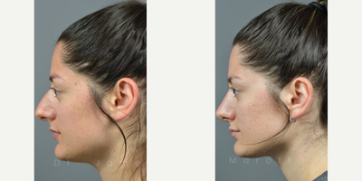 Woman treated with Rhinoplasty - 1 year Rhinoplasty follow up and this patient