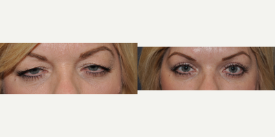 45-54 year old woman treated with Eyelid Surgery - This patient had an upper eyelid Blepharoplasty as well as a ptosis repair (internal levator resection).