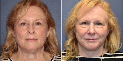 Woman treated with Facelift - Woman treated with Facelift