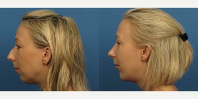 Woman treated with Rhinoplasty - Woman treated with Rhinoplasty