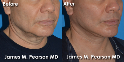 55-64 year old man treated with Facelift - 55-64 year old man treated with Facelift and Neck Lift